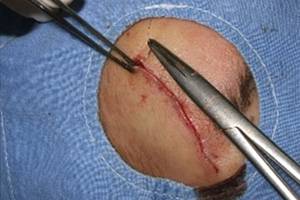 局所麻酔をして、創部をよく洗浄し、縫合は形成外科的な手技で行います。