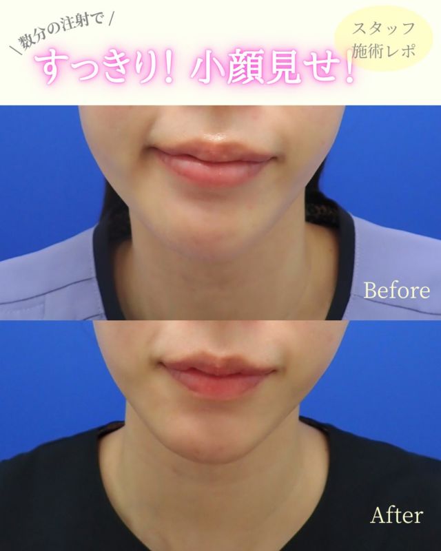 .
こんにちは、ぎふスキンケアクリニック カウンセラーのSです🎀

昨年の年末、新しく入職された牧野先生に、エラボトックスを打っていただきました૮ ◜ᵕ◝ ა💉🎶

〈 エラボトックス こんな人におすすめ 〉
・食いしばり癖、歯ぎしり癖がある人
・奥歯を食いしばるとポコっとエラが張る人
・切らずに小顔効果がほしい人

1週間後くらいから、クリニックのスタッフや、友人に、顔がしゅっとして小顔になったと言われました❕🩷

痛みも我慢できる程度で、内出血も私は全く出ませんでした🫶🏻 ✦ .　⁺　˖ . 
大満足だったので、また半年置きくらいで継続していきたいと思ってます₍ᐡ ɞ̴̶̷ ̫ ᴗ̤ ᐡ₎ ᯤ ♡

#エラボトックス #咬筋ボトックス #小顔治療 #岐阜美容医療 #岐阜美容クリニック